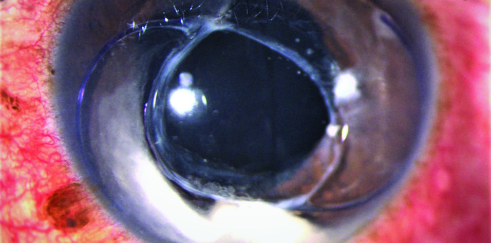 CRST Global | IOL–Capsular Bag Complex in the Anterior Chamber